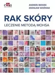 Rak skóry Leczenie metodą Mohsa - Andrzej Bieniek, Zdzisław Woźniak