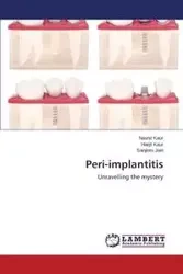 Peri-implantitis - Kaur Navnit