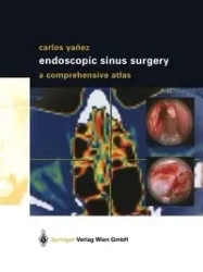 Endoscopic Sinus Surgery - Carlos Yanez