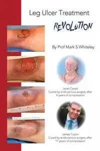 Leg Ulcer Treatment Revolution - Mark Whiteley S