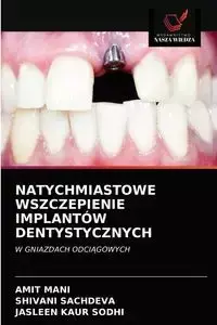 NATYCHMIASTOWE WSZCZEPIENIE IMPLANTÓW DENTYSTYCZNYCH - MANI AMIT