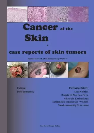 eBook Cancer of the Skin - case reports of skin tumors - Piotr Brzezinski epub