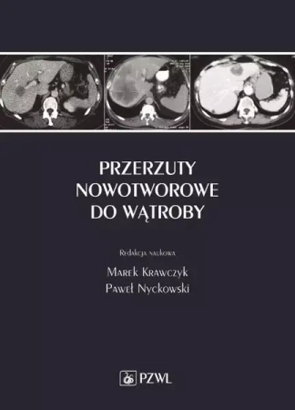 eBook Przerzuty nowotworowe do wątroby - Marek Krawczyk epub mobi